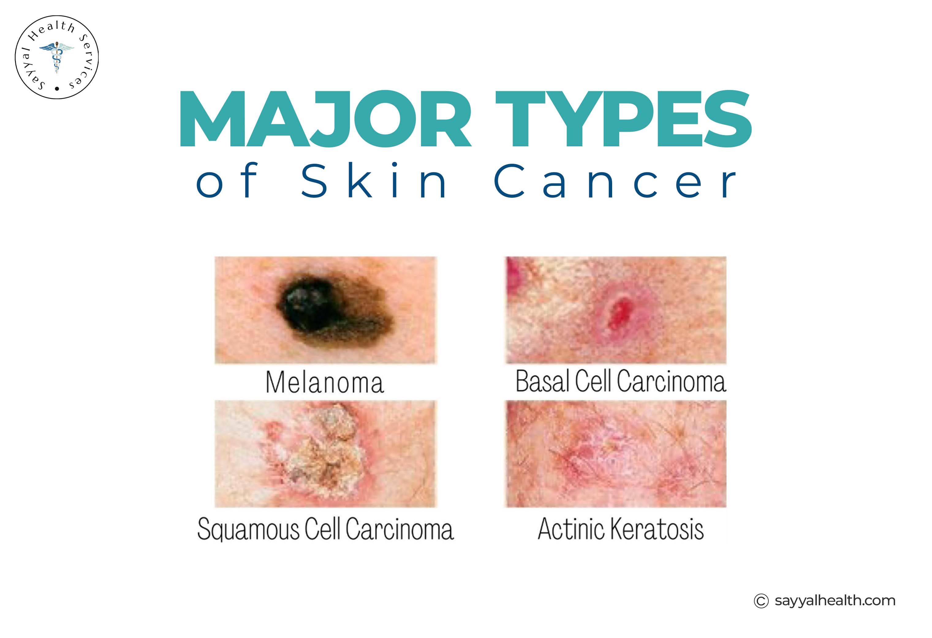 major types of skin cancer